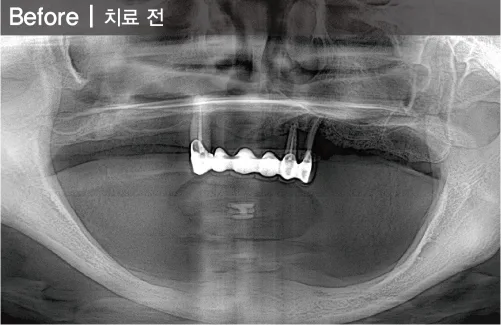 틀니마저 포기하신 환자분 치료 전